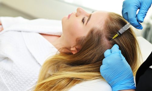 Trattamento PRP per i Capelli