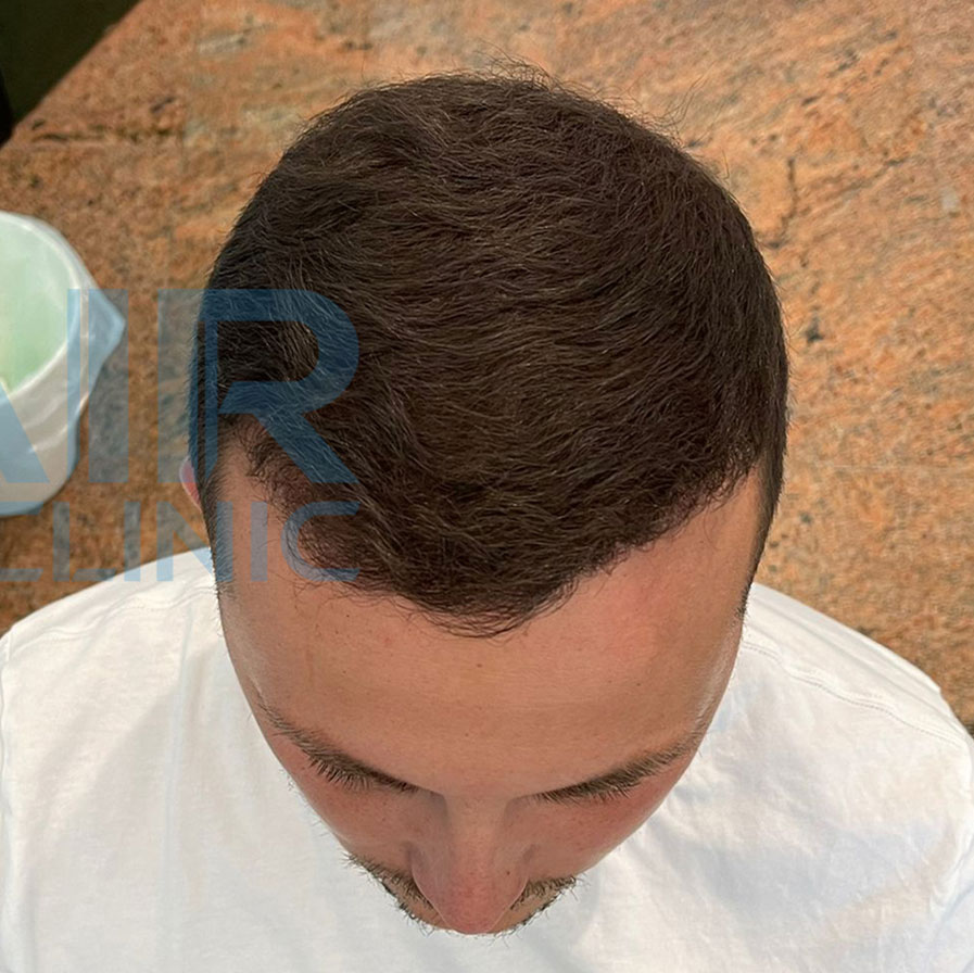 Terapia laser dopo il trapianto di capelli