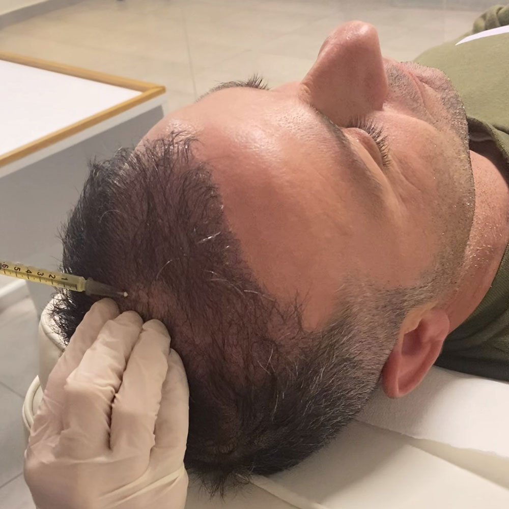 Miglior Trattamento PRP per Capelli a Tirana