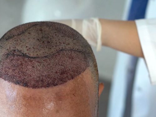 Hair Transplant is the Best Method to Restore Natural Hair