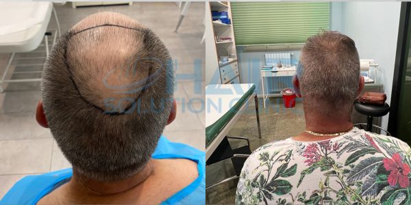 trapianto capelli tirana