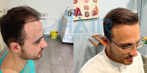 trapianto capelli tirana