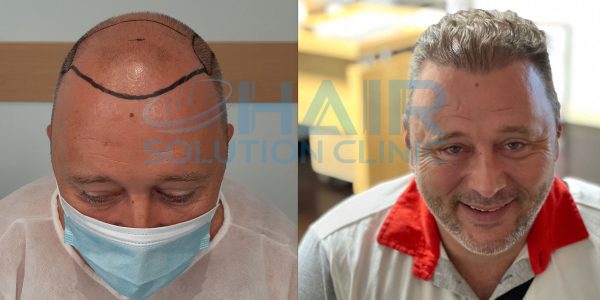 trapianto capelli tirana