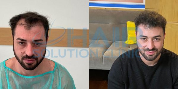 trapianto capelli tirana