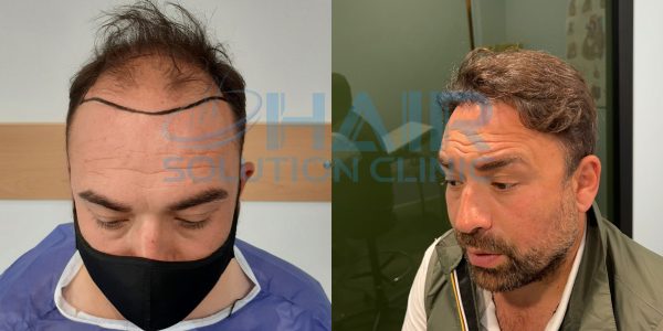 trapianto capelli tirana
