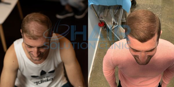 trapianto capelli tirana