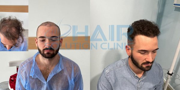 trapianto capelli tirana