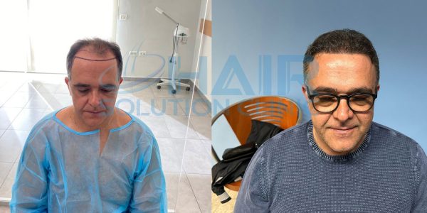 trapianto capelli tirana