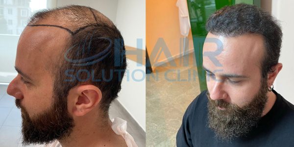 trapianto capelli tirana