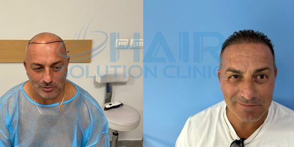 trapianto capelli tirana