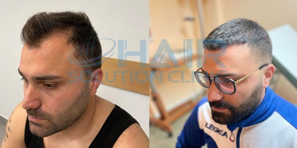 trapianto capelli tirana