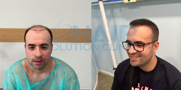 trapianto capelli tirana