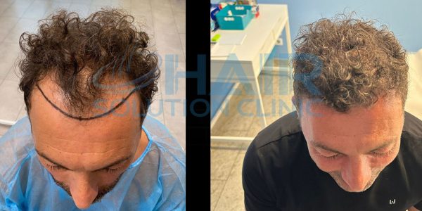 trapianto capelli tirana