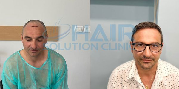 trapianto capelli tirana