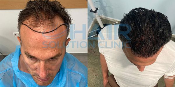 trapianto capelli tirana