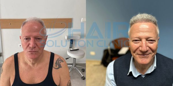 trapianto capelli tirana