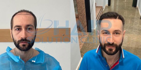 trapianto capelli tirana