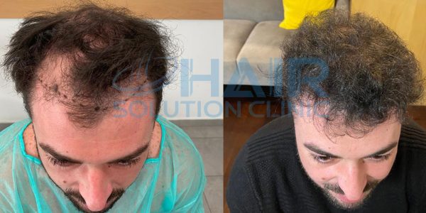 trapianto capelli tirana